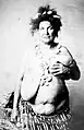 Hypertrophy of breast, c. 1870