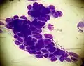 A cluster of basaloid cells on a smear taken from a patient with basal cell carcinoma (May-Grünwald Giemsa x1000).
