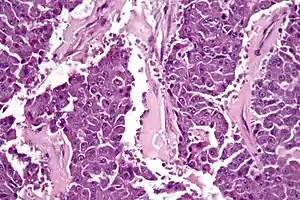 Pancreatic cancer cell in high magnification