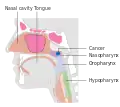 Stage T1 nasopharyngeal cancer