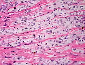 Poorly differentiated, where attempts at keratinization are often no longer evident. This is a clear-cell squamous-cell carcinoma. The dysplastic cells infiltrated cords through the dermis. Poorly differentiated cSCC has greatly enlarged pleomorphic nuclei showing a&nbsp;high degree of atypia and frequent mitoses.