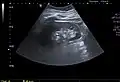 A very small (8&nbsp;mm) simple renal cyst.